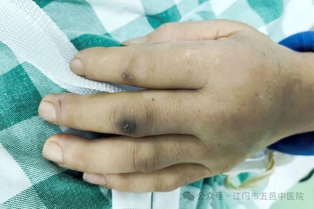九游娱乐：切了块生猪肉男子头痛欲裂险些丧命！罪魁祸首是……(图2)